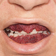 Imagen para el artículo titulado La peligrosa afección de la gingivitis de fresa: cuando las encías están tan inflamadas que parecen a punto de explotar